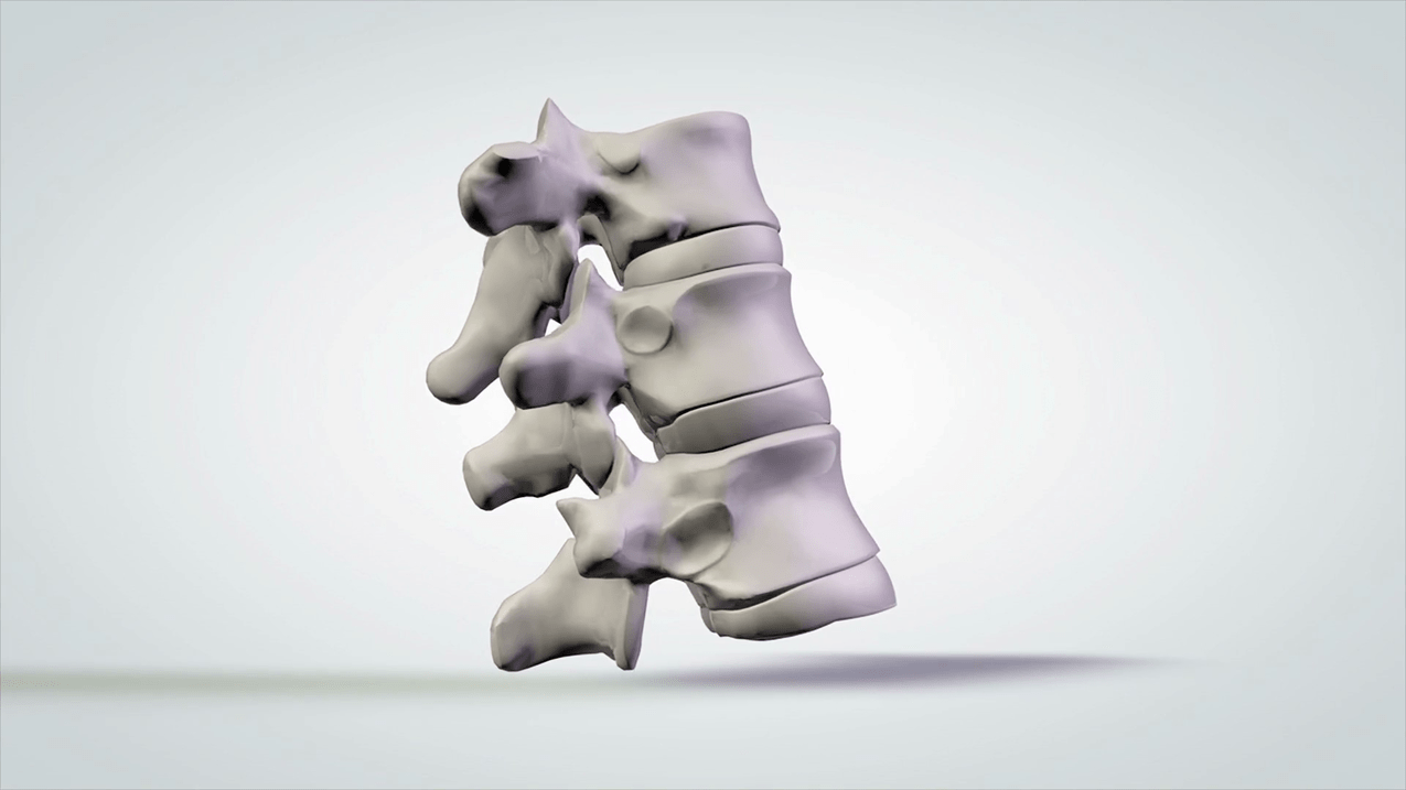 Wirbelsäulenverletzung bei zervikaler Osteochondrose